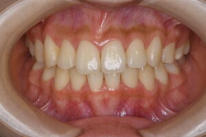 福岡天神｜渡辺通さとう歯科・矯正歯科 20代女性の裏側矯正後のきれいな正面写真