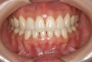 福岡天神｜渡辺通さとう歯科・矯正歯科｜歯茎のピーリング