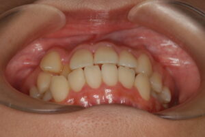 福岡天神｜渡辺通さとう歯科・矯正歯科 20代女性の裏側矯正前の前歯の咬み合わせ写真