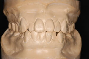 矯正治療前の八重歯の模型