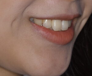 福岡天神｜渡辺通さとう歯科・矯正歯科 20代女性の裏側矯正後の笑顔写真