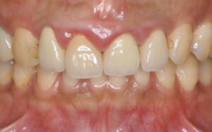 福岡市 前歯セラミック 適合不良 歯ぐきの腫れ Before