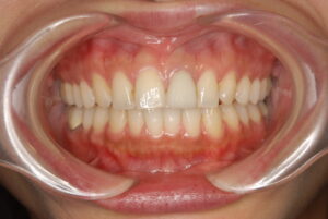 不自然なセラミック｜福岡天神