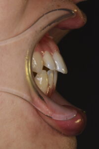 他院で矯正治療を受けたが噛み合わせが不安定で出っ歯が残っている写真｜福岡天神