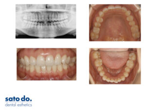 福岡天神|治療前の写真んとレントゲン
