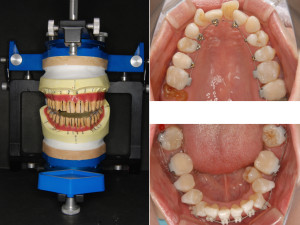 福岡市天神｜渡辺通さとう歯科・矯正歯科｜40代女性の精密な治療設計に基づいたカスタムメイドの矯正治療