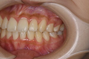 福岡天神｜渡辺通さとう歯科・矯正歯科 20代女性の裏側矯正後のきれいな左側歯並び写真