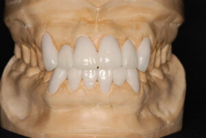 八重歯を差し歯で治した場合の模型写真｜福岡天神｜渡辺通さとう歯科・矯正歯科