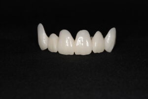 つながった不自然な差し歯｜福岡天神｜渡辺通さとう歯科・矯正歯科