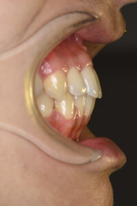 福岡天神｜渡辺通さとう歯科・矯正歯科｜矯正のやり直し後の写真