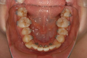 福岡天神｜渡辺通さとう歯科・矯正歯科 20代女性の裏側矯正中の下顎写真