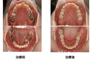 福岡市天神｜渡辺通さとう歯科・矯正歯科40代女性の銀歯をセラミックに変えて矯正治療も行った治療前後の比較写真