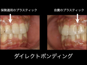 福岡天神｜渡辺通さとう歯科・矯正歯科｜ダイレクトボンディングの違い