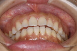 他院でマウスピース矯正を受けるも前歯で全く噛めない40代女性の写真｜福岡天神|渡辺通さとう歯科・矯正歯科