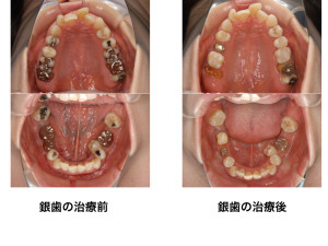 福岡天神｜渡辺通さとう歯科・矯正歯科40代女性の矯正前の銀歯治療の前と後の写真