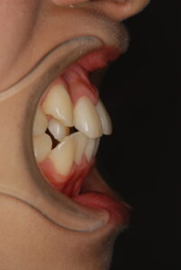 福岡天神｜渡辺通さとう歯科・矯正歯科 20代女性の裏側矯正前の横からの前歯写真