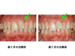 福岡市天神｜渡辺通さとう歯科・矯正歯科40代女性の矯正治療前の歯周病治療前と後の歯茎の状態