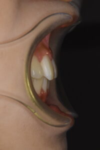 福岡天神｜渡辺通さとう歯科・矯正歯科 20代女性の裏側矯正後のきれいな前歯の写真