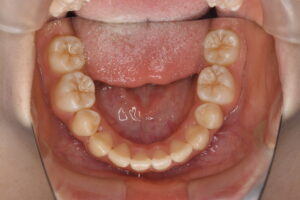 福岡天神｜渡辺通さとう歯科・矯正歯科 20代女性の裏側矯正後のきれいな下顎歯並び写真