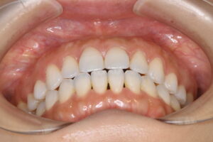 前歯で全く噛めない40代女性を裏側ワイヤー矯正でやり直して咬み合わせが安定した写真｜福岡天神|渡辺通さとう歯科・矯正歯科