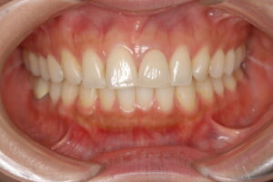 福岡天神｜自然な美しいセラミックの写真