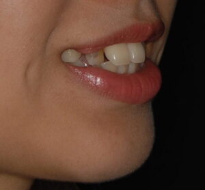 福岡天神｜渡辺通さとう歯科・矯正歯科 20代女性の裏側矯正前の笑顔写真