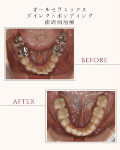 福岡 天神 日曜診療 セラミックのビフォーアフター症例写真