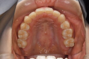 福岡天神｜渡辺通さとう歯科・矯正歯科 20代女性の裏側矯正後のきれいな上顎歯並び写真