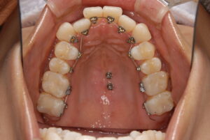 福岡天神｜渡辺通さとう歯科・矯正歯科｜八重歯の裏側矯正