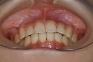 福岡天神｜渡辺通さとう歯科・矯正歯科 20代女性の裏側矯正後のきれいな前歯の咬み合わせ写真