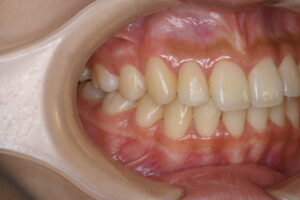 福岡天神｜渡辺通さとう歯科・矯正歯科 20代女性の裏側矯正後のきれいな右側歯並び写真