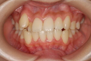 福岡天神｜渡辺通さとう歯科・矯正歯科 20代女性の裏側矯正前の正面写真