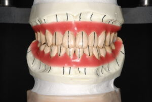 矯正用のシミュレーション模型の写真｜福岡天神｜渡辺通さとう歯科・矯正歯科