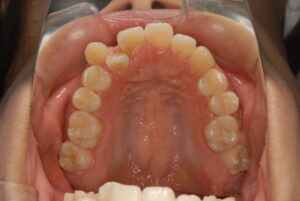 福岡天神｜渡辺通さとう歯科・矯正歯科 20代女性の裏側矯正前の上顎歯並び写真