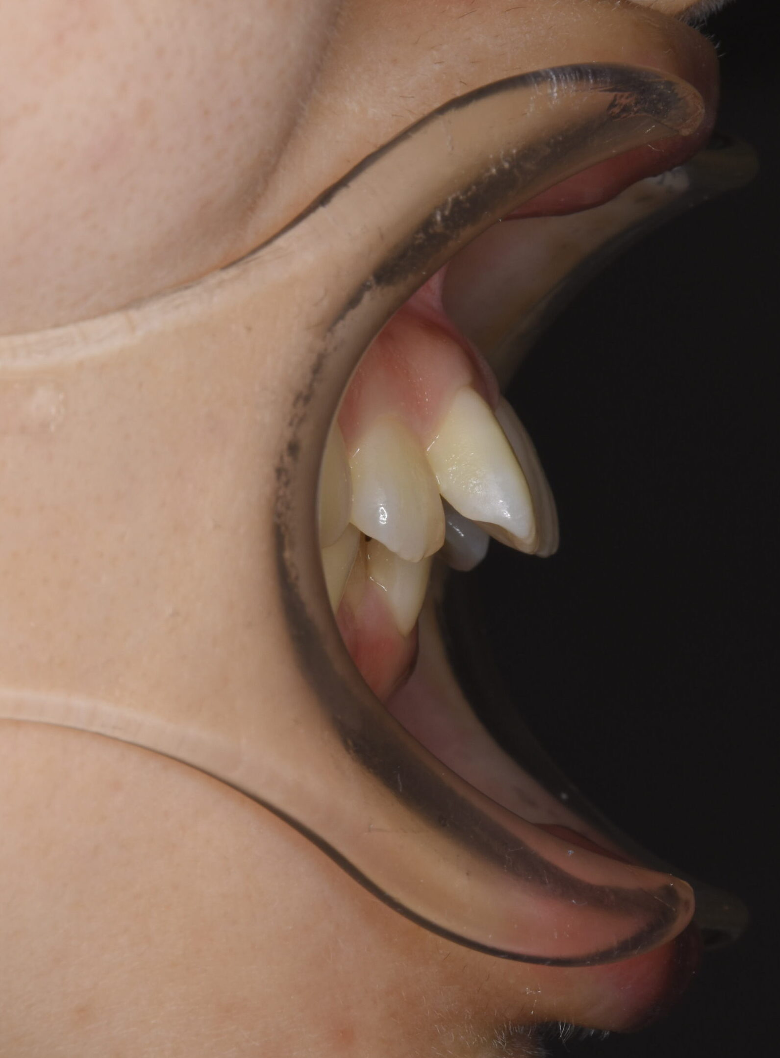 30〜50代女性に選ばれる理由|マウスピース矯正の不安から確実に治す裏側矯正|口ゴボ・出っ歯【福岡天神】