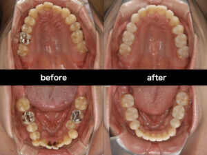 福岡天神|渡辺通さとう歯科・矯正歯科治療前後の比較写真