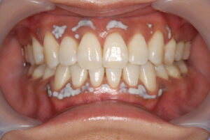 歯茎のピーリング中の写真｜福岡天神｜渡辺通さとう歯科・矯正歯科