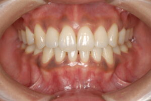 八重歯を矯正治療後の写真｜福岡天神｜渡辺通さとう歯科・矯正歯科